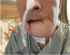 『缺一口』都不行   談口腔癌患者的吞嚥及語言訓練(相關圖片)