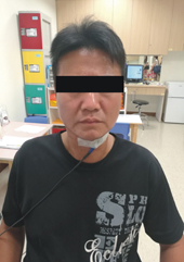 『缺一口』都不行   談口腔癌患者的吞嚥及語言訓練(相關圖片)