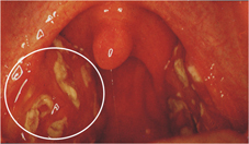 經常喉嚨痛是感冒惹的禍嗎？ 可能罹患『慢性扁桃腺炎』(相關圖片)