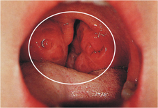 經常喉嚨痛是感冒惹的禍嗎？ 可能罹患『慢性扁桃腺炎』(相關圖片)