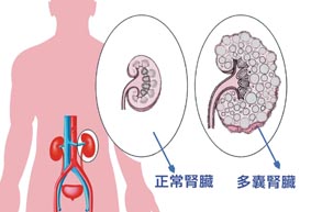 泡泡危機  『多囊腎』最新治療(相關圖片)