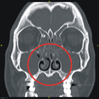 頭頸外科裡的GPS      指引手術不迷航(相關圖片)