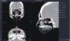 頭頸外科裡的GPS      指引手術不迷航(相關圖片)