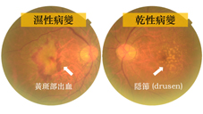 銀髮族的視力殺手  七問:『老年性黃斑部病變』(相關圖片)