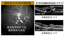 銀髮族的視力殺手  七問:『老年性黃斑部病變』(相關圖片)