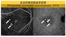 銀髮族的視力殺手  七問:『老年性黃斑部病變』(相關圖片)