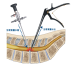 脊椎微創手術新境界   雙通道內視鏡脊椎微創手術(相關圖片)