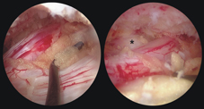 脊椎微創手術新境界   雙通道內視鏡脊椎微創手術(相關圖片)