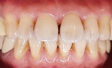 皮膚要美白  你知道牙齒也可以美白嗎?(相關圖片)