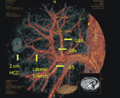 手術室裡的『火金姑』  螢光導引手術(相關圖片)
