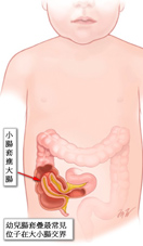 暗藏危機的嬰幼兒腹痛與間歇性哭鬧   談『腸套疊』(相關圖片)