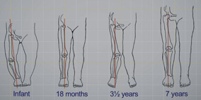 兒童X與O型腿與微創矯正手術(相關圖片)