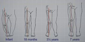 兒童X與O型腿與微創矯正手術(相關圖片)