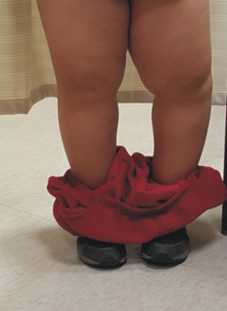 兒童X與O型腿與微創矯正手術(相關圖片)