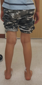 兒童X與O型腿與微創矯正手術(相關圖片)