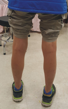 兒童X與O型腿與微創矯正手術(相關圖片)