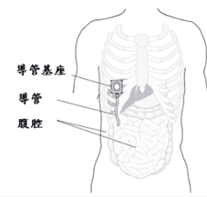 腹腔內化療及前哨淋巴造影於婦癌(相關圖片)