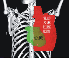 智慧擋塊螺旋刀「全心」守護您  讓乳癌抗癌不用再「傷心」(相關圖片)