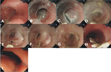 『經口內視鏡括約肌切開術』  POEM治療胃食道蠕動異常疾病(相關圖片)