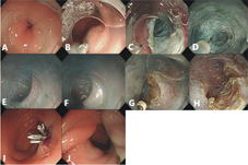 『經口內視鏡括約肌切開術』  POEM治療胃食道蠕動異常疾病(相關圖片)