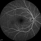 『光學同調斷層掃描血管攝影』於糖尿病視網膜病變的應用(相關圖片)