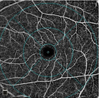 『光學同調斷層掃描血管攝影』於糖尿病視網膜病變的應用(相關圖片)