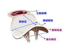 退化性僧帽瓣逆流及修復手術(相關圖片)