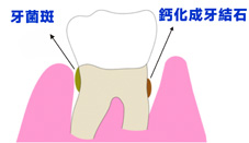 細菌是問題的根源  當心『牙周病』找上門？(相關圖片)