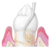 細菌是問題的根源  當心『牙周病』找上門?(相關圖片)
