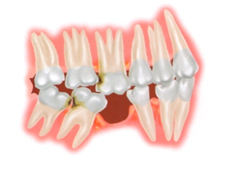 缺牙危機    少了顆牙怎麼辦?(相關圖片)