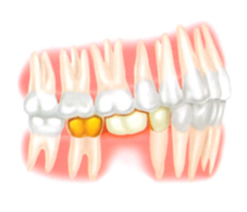 缺牙危機    少了顆牙怎麼辦？(相關圖片)