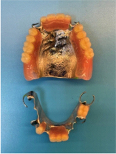 缺牙危機    少了顆牙怎麼辦?(相關圖片)