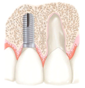 缺牙危機    少了顆牙怎麼辦?(相關圖片)