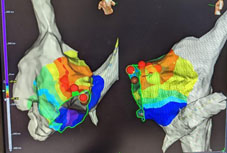 心律不整治療新趨勢  零輻射的3D立體定位系統燒灼術(相關圖片)