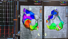 心律不整治療新趨勢  零輻射的3D立體定位系統燒灼術(相關圖片)