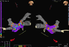 心律不整治療新趨勢  零輻射的3D立體定位系統燒灼術(相關圖片)