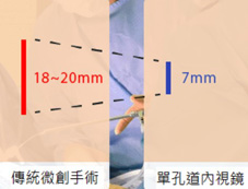 傷口小、恢復快  談單孔道內視鏡脊椎手術(相關圖片)