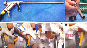 傷口小、恢復快  談單孔道內視鏡脊椎手術(相關圖片)