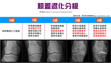 僵硬、疼痛  談退化性關節炎(相關圖片)