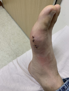 關於痛風石手術七個常見問題  幫助你遠離痛風石(相關圖片)