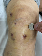 關於痛風石手術七個常見問題  幫助你遠離痛風石(相關圖片)