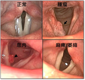 喉頻閃光源內視鏡  讓聲帶病灶無所遁形(相關圖片)