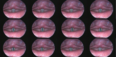 喉頻閃光源內視鏡  讓聲帶病灶無所遁形(相關圖片)