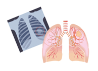 低劑量電腦斷層肺癌篩檢的重要性(相關圖片)