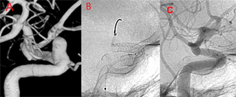 頭痛勿輕忽小心致命炸彈     腦動脈瘤需定期磁振造影追蹤(相關圖片)