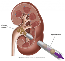 讓結石不再遁形    治療腎臟結石新選擇 「軟式輸尿管鏡」(相關圖片)