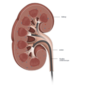 讓結石不再遁形    治療腎臟結石新選擇 「軟式輸尿管鏡」(相關圖片)