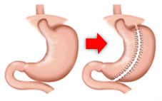 避免復胖及減肥的痛苦   談微創腹腔鏡手術(相關圖片)