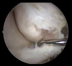 為何會…  反覆腳踝扭傷疼痛與踝韌帶斷裂(相關圖片)