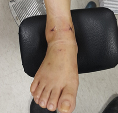 為何會…  反覆腳踝扭傷疼痛與踝韌帶斷裂(相關圖片)